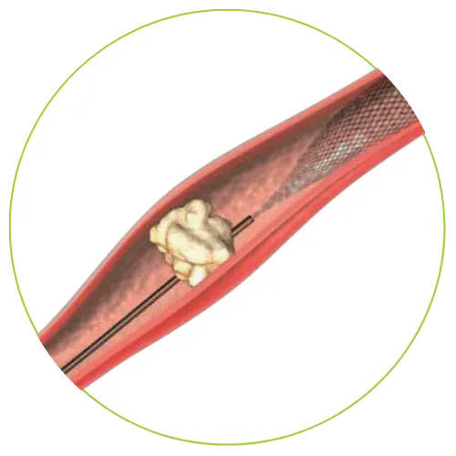 X-Filter schritt2 img